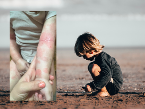 dermatitis child